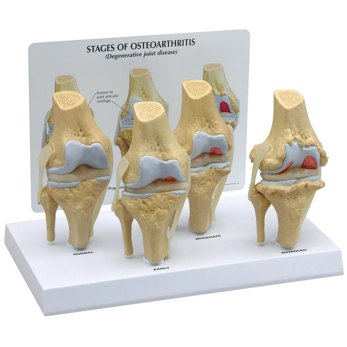 Modèle: Les 4 stades du genou ostéoarthritique