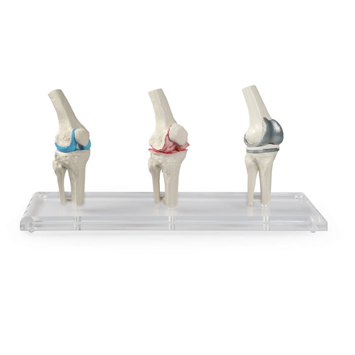 Three knee joint models: healthy, diseased and with implant