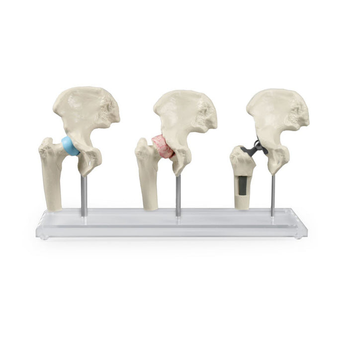 Three hip joint models healthy, diseased and with implant