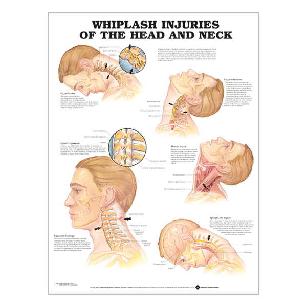 Charte « Whiplash injuries of the head and neck »